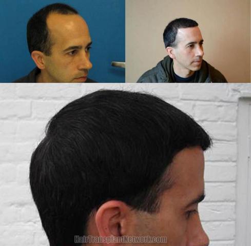 Hair transplantation surgery before and after pictures