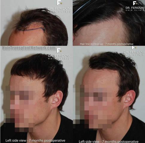 Left view before and after hair restoration procedure