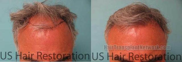 Top view before and after hair restoration results