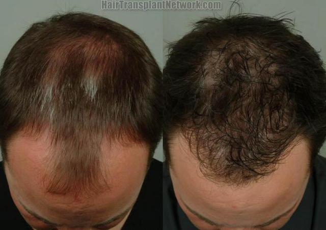 Top view before and after hair restoration results