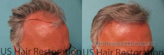 Before and after hair transplant procedure images