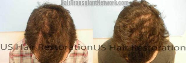 Before and after hair restoration procedure result photos