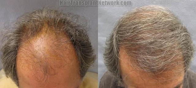 Hair transplantation surgery before and after images