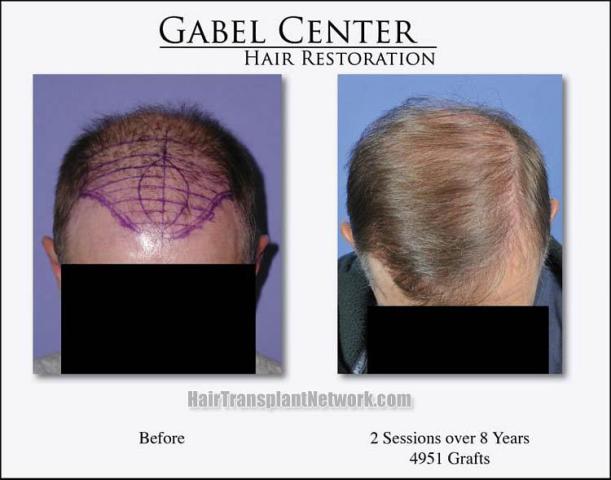 Top view - Before and after surgical hair replacement