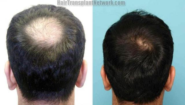 Before and after hair transplantation procedure 