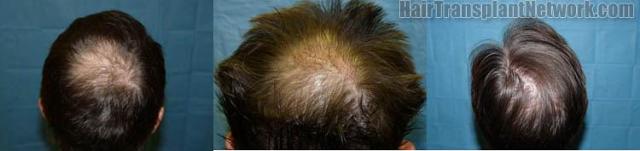 View of patient's crown before and after hair restoration