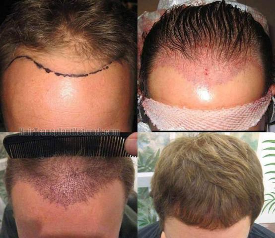 Before and after hair transplant procedure images