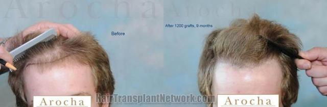 Hair transplantation surgery before and after photos