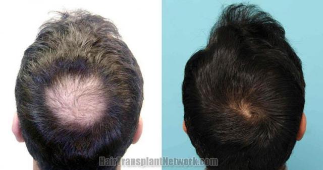 Hair restoration before and after photographs