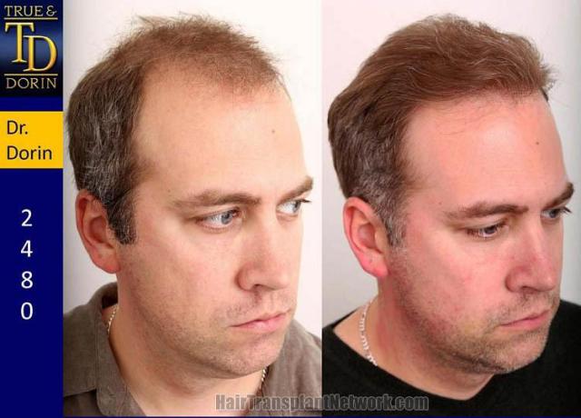 Hair restoration procedure before and after results