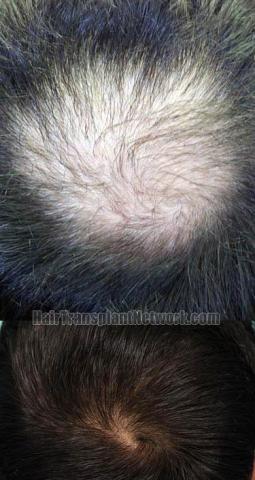 Hair restoration procedure results