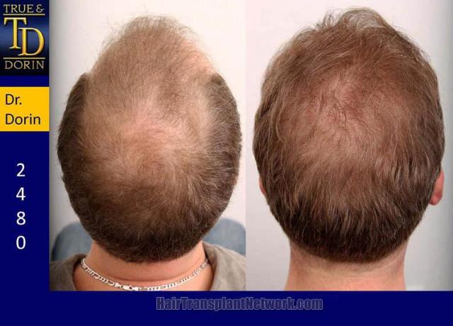 Hair transplantation surgery before and after photos