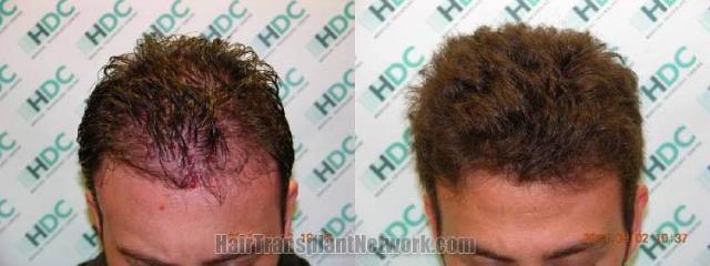 Top view before and after hair restoration results