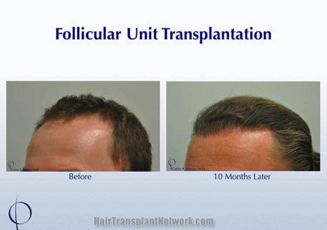 Hair transplantation surgery before and after pictures