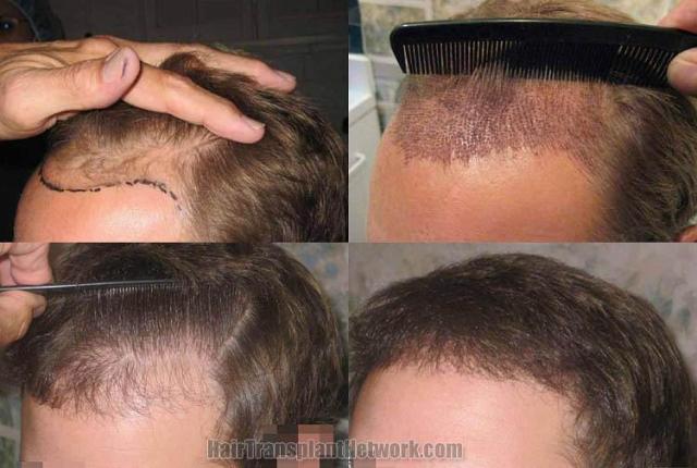 Hair transplantation surgery before and after photos