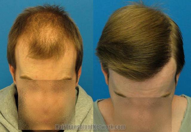 Hair restoration surgery before and after photos