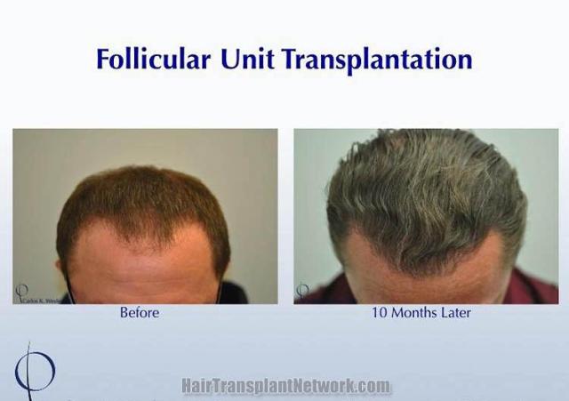 Hair transplantation surgery before and after photos