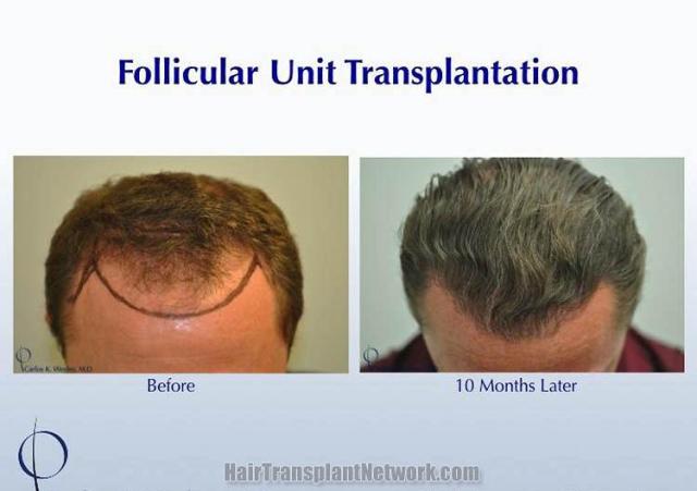 Hair restoration surgery before and after photos