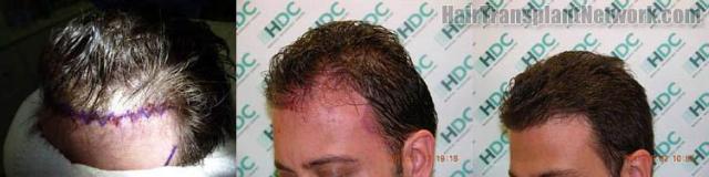 Hair transplantation surgery before and after photos