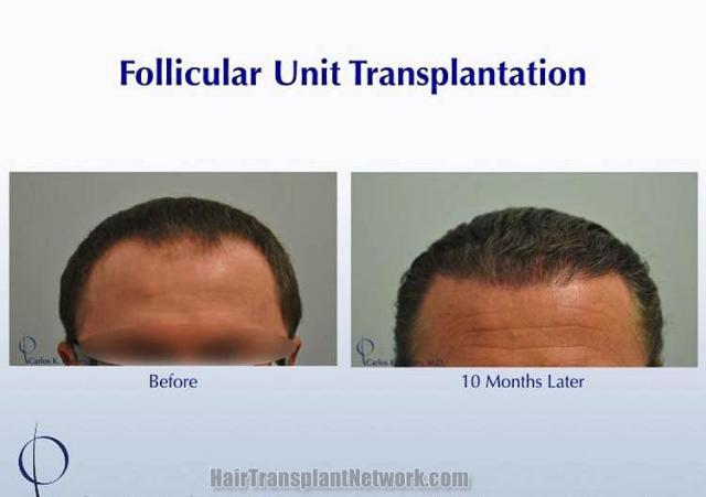 Hair restoration procedure before and after results