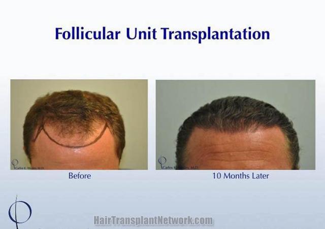 Hair restoration procedure before and after pictures