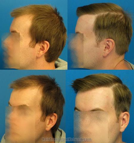 Hair transplantation surgery before and after pictures