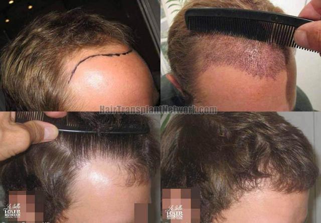 Hair restoration procedure before and after results