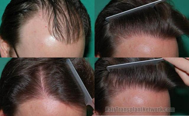 Hair restoration procedure before and after results