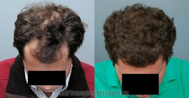 Top view - Before and after surgical hair replacement