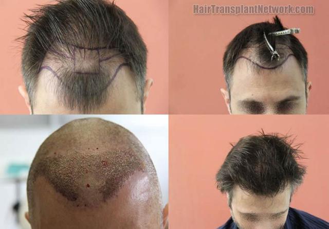 Top view before and after hair restoration results