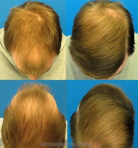 Hair transplantation surgery before and after photos