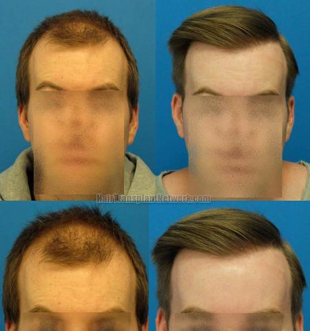 Hair restoration procedure before and after results