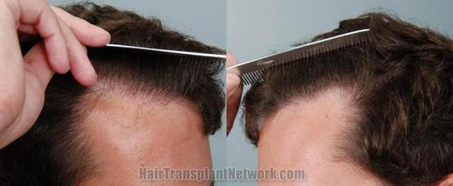 Surgical hair transplantation result photographs