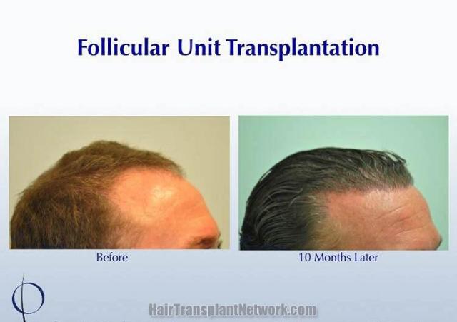 Hair transplantation surgery before and after images