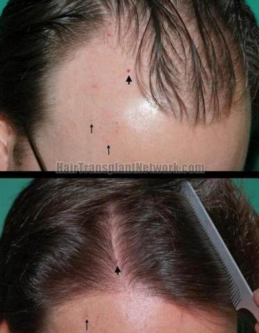 Hair restoration procedure before and after pictures