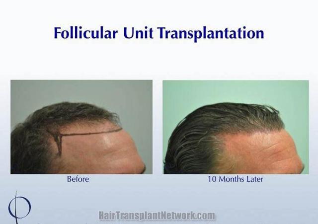 Hair restoration surgery before and after images