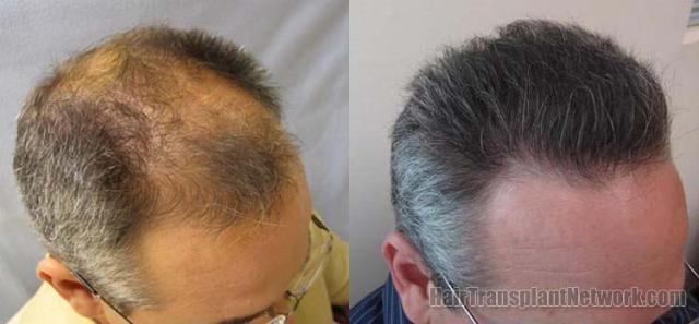 Hair restoration procedure before and after results