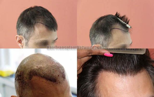 Hair restoration procedure before and after results