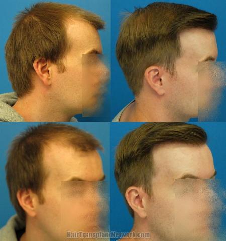 Hair transplantation surgery before and after images