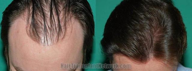 Top view before and after hair restoration results