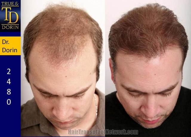 Before and after hair transplantation result photographs