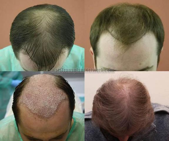 Hair restoration procedure before and after pictures