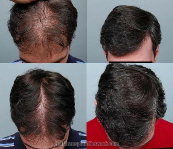 Top view - Before and after hair transplant repair