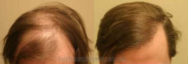 Hair transplantation surgery before and after photos