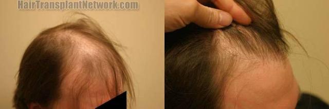 Hair transplantation surgery before and after pictures