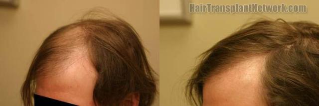 Hair restoration procedure before and after pictures