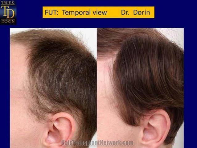 Surgical hair transplantation result photographs