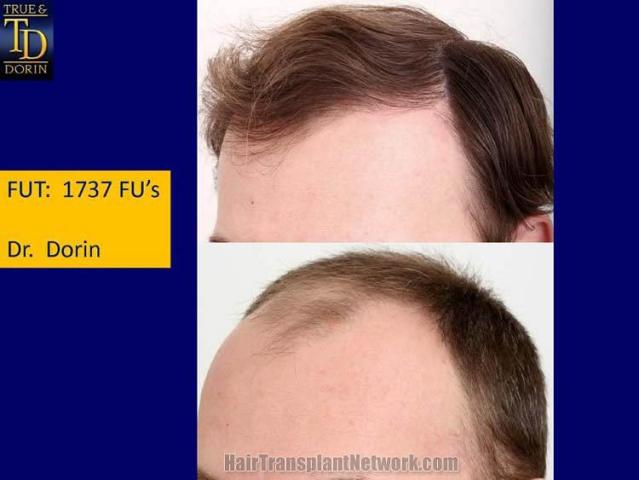 Hair restoration procedure before and after pictures