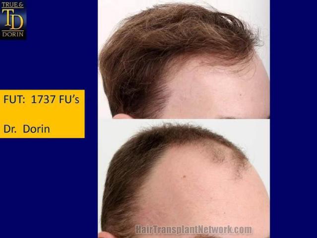 Hair restoration procedure before and after results