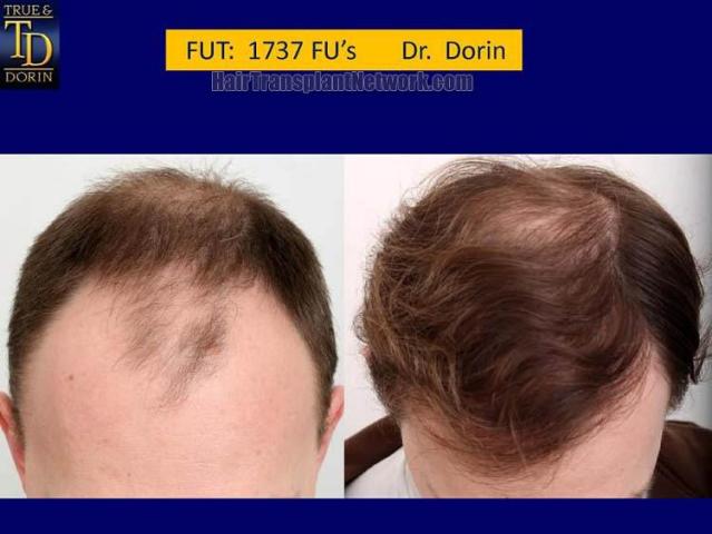 Top view before and after hair restoration results